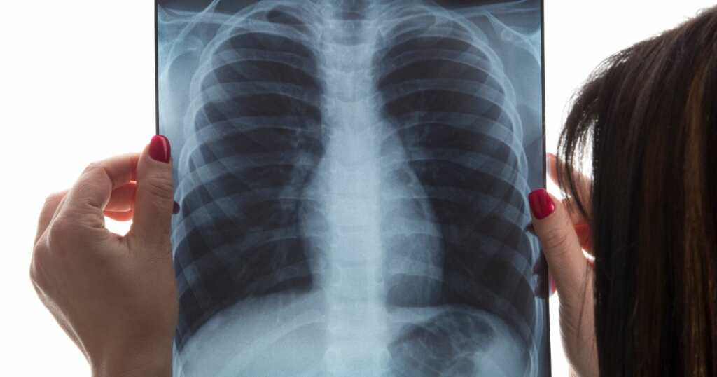 XR - Asthma - after Cannabis treatment