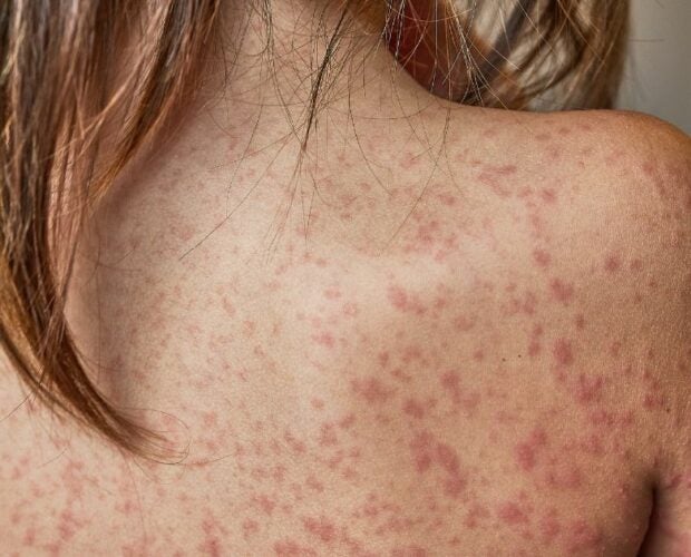 Woman back with eczema