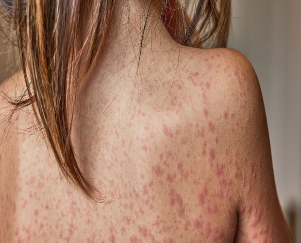 Woman back with eczema