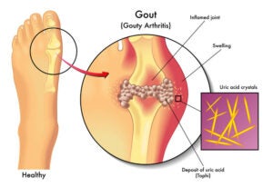 can weed cause gout