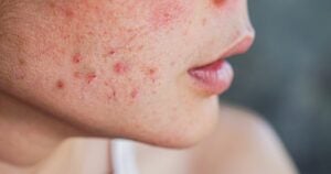 Close up of acne-prone skin. There are red-coloured pimples on the cheek.