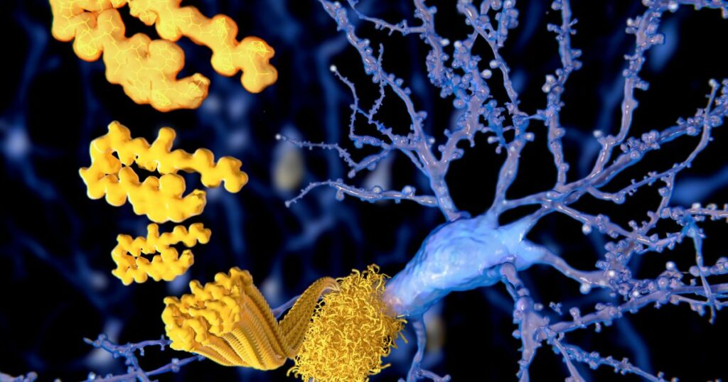 Amyloid plagues, beta amyloids depicted in yellow are stuck together with blue net looking strings.