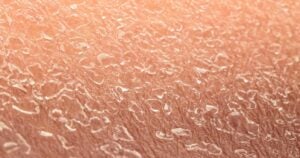 Clos-up shot of dry skin, there are scaly marks on the surface of the skin.