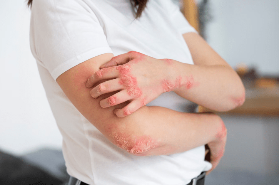 From Itchy to Calm: Discover the Healing Properties of Cannabis Oil for Eczema