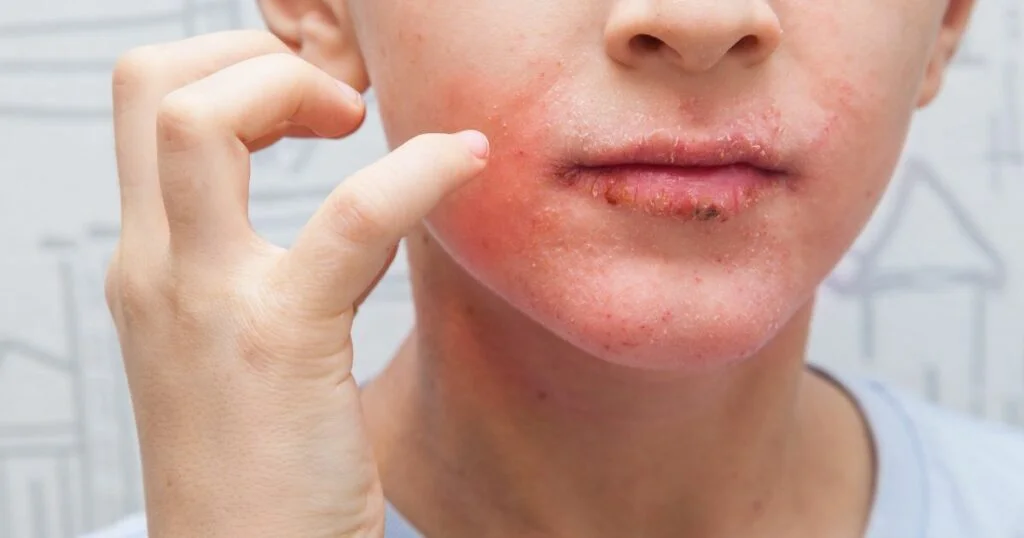 Young person with visibly dry mouth. Redness in the cheek and lips are dry with scabs.