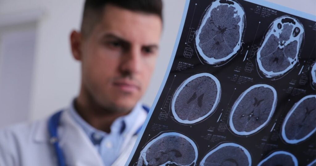 A doctor looking at a scan of the brain to check for multiple sclerosis.