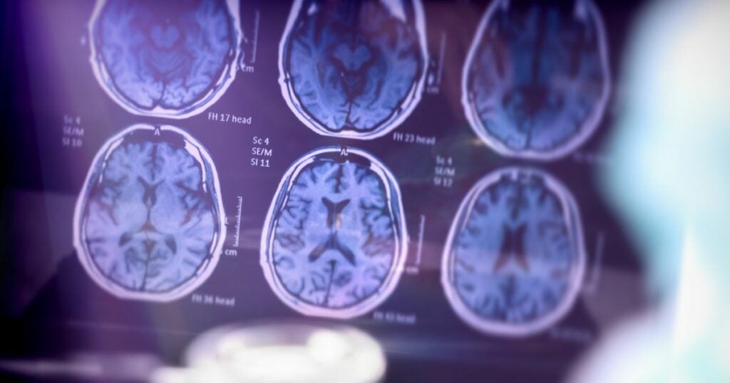 Alzheimer's disease - radiography - brain - XR