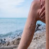 Varicose Veins - need relief