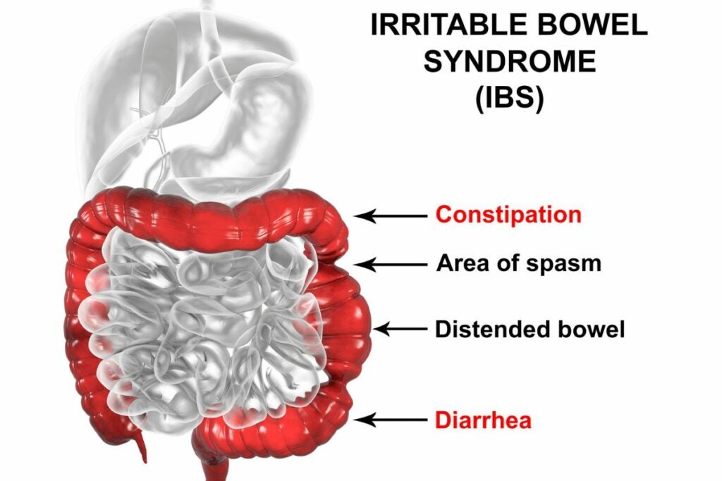 An infographic for Irritable Bowel Syndrome. A diagram shows the digestive system and where constipation, spasms, distended bowels and diarrhea happen in the digestive system.
